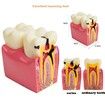 Dental Teeth Model Dental Caries Tooth Model Patient Education Teeth Model 6 Times Caries