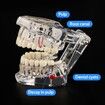 Transparent Disease Teeth Model with Dental Implant Bridge,Dental Model for Patient and Dental Student Education