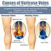 36PCS Varicose Veins Patch Relief Treatment for Legs, Spider Varicose Vein, Strengthen Capillary Health and Improve Blood Circulation