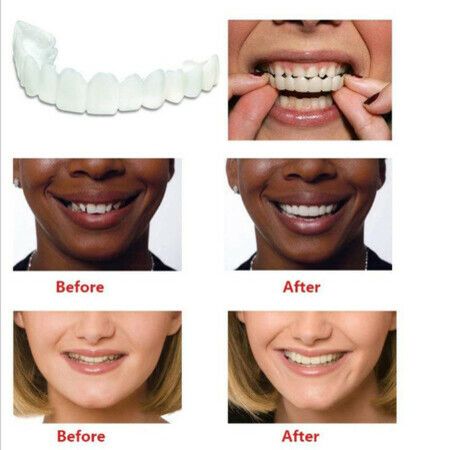 Temporary Teeth for Men and Women, Covers Imperfect Teeth, No Pain, No Shots, No Drilling, to Fix a Confident Smile (1 Pack)