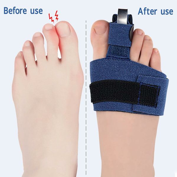 Big Toe Splint Universal Corrective, Big Toe Straightener Big Toe Support Hammer Aluminum Strip Promotes Recovery