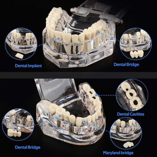 Transparent Disease Teeth Model with Dental Implant Bridge,Dental Model for Patient and Dental Student Education