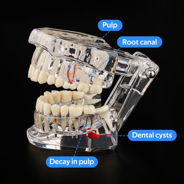 Transparent Disease Teeth Model with Dental Implant Bridge,Dental Model for Patient and Dental Student Education