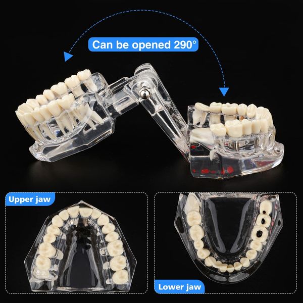 Transparent Disease Teeth Model with Dental Implant Bridge,Dental Model for Patient and Dental Student Education