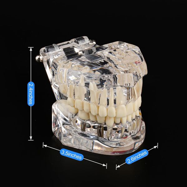 Transparent Disease Teeth Model with Dental Implant Bridge,Dental Model for Patient and Dental Student Education