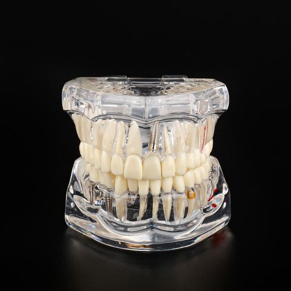 Transparent Disease Teeth Model with Dental Implant Bridge,Dental Model for Patient and Dental Student Education