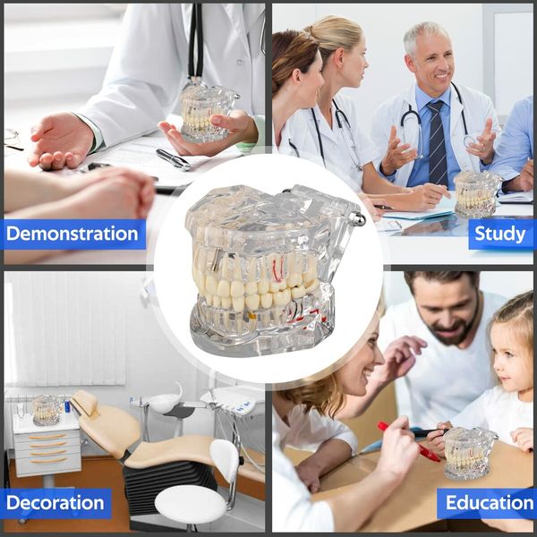 Transparent Disease Teeth Model with Dental Implant Bridge,Dental Model for Patient and Dental Student Education