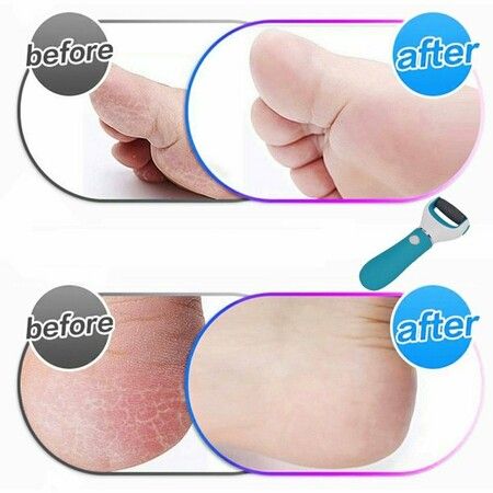 Professional Electronic Foot File: Effortlessly Remove Calluses and Reveal Smooth Feet