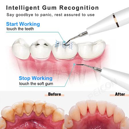 Professional Ultrasonic Dental Scaler - Effortlessly Remove Tartar and Stains