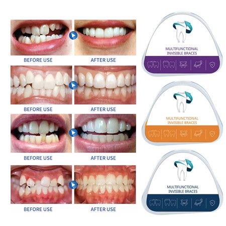 3-Stage Dental Orthodontic Braces/Teeth Retainer/Bruxism Mouth Guard-Correct Misalignment,Prevent Bruxism