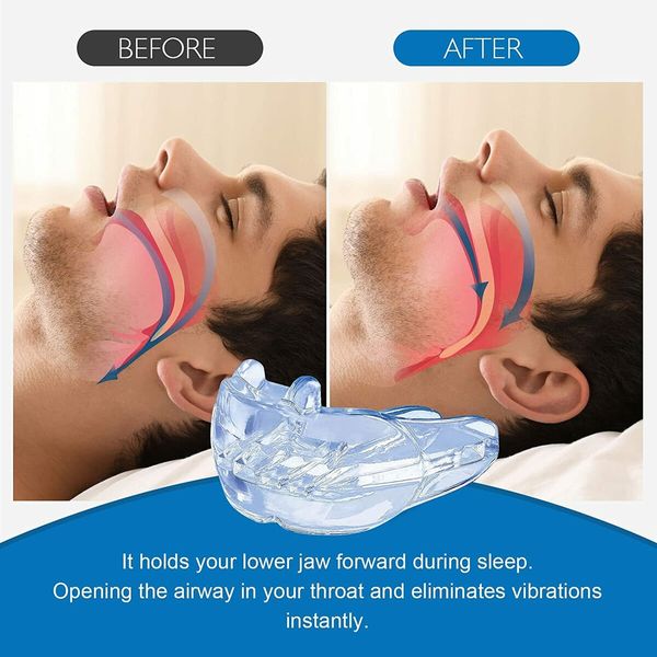 Anti-Snoring Mouthpiece for a Better Night's Sleep for Men/Women (Comfortable and Effective)