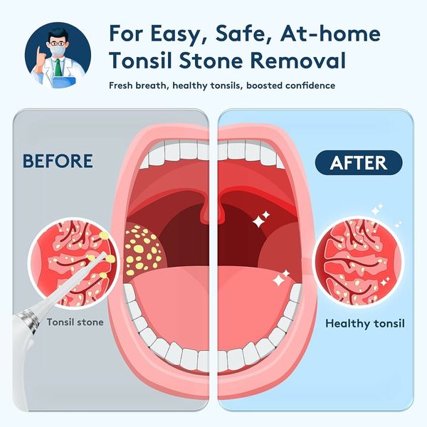 Electronic Vacuum Tonsil Stone Remover with Built in LED Light with 3 Levels Suction, Instant Suction, White