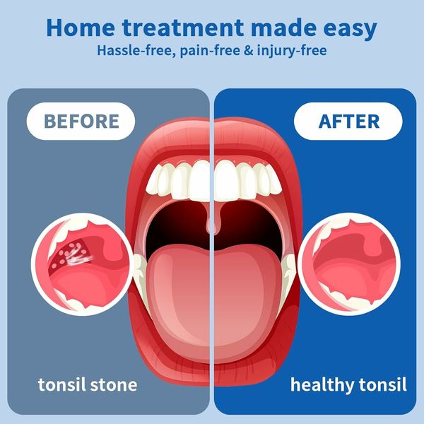 Electronic Tonsil Stone Remover Vacuum，7 in 1 Tonsil Stone Removal Kit, Fight Bad Breath, Mouth Cleaning Oral Care, White